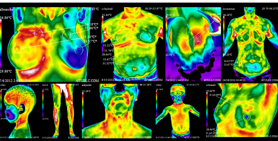 Thermography